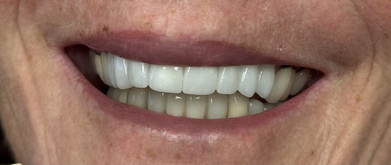 Close-up of a happy patient's smile