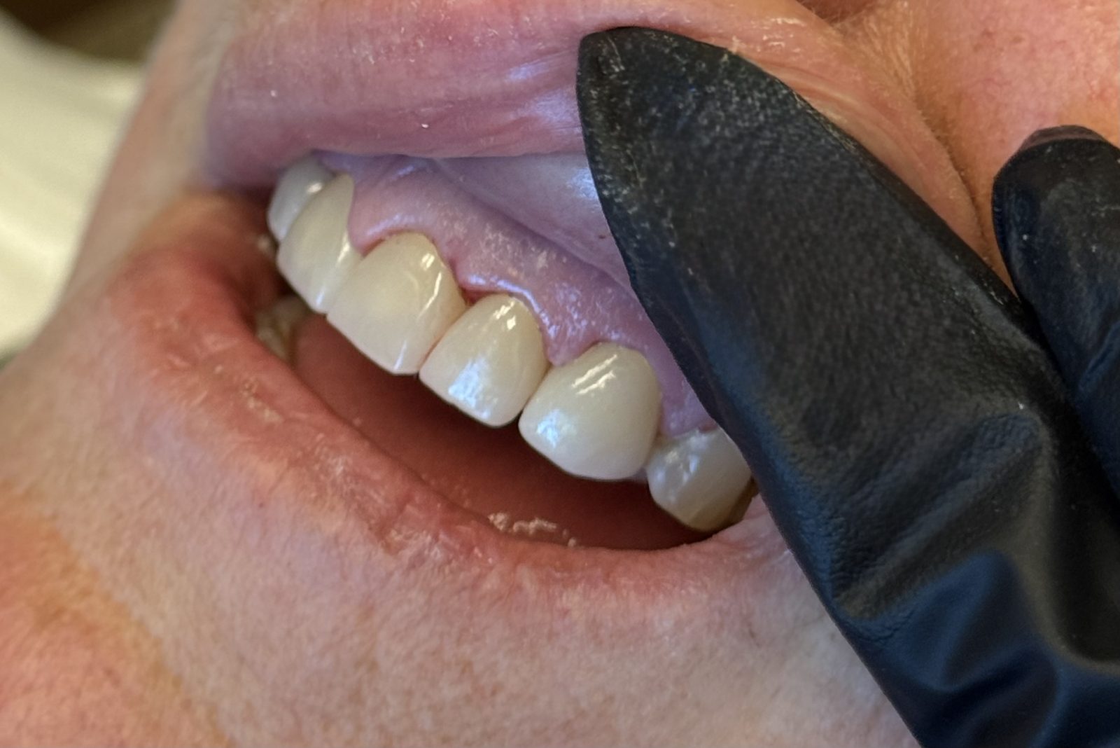 Dentist checking the fit of a same-day dental crown