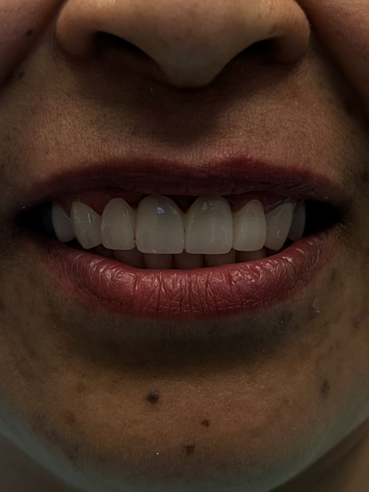 Close-up of a patient's smile showing natural-looking cosmetic dental work
