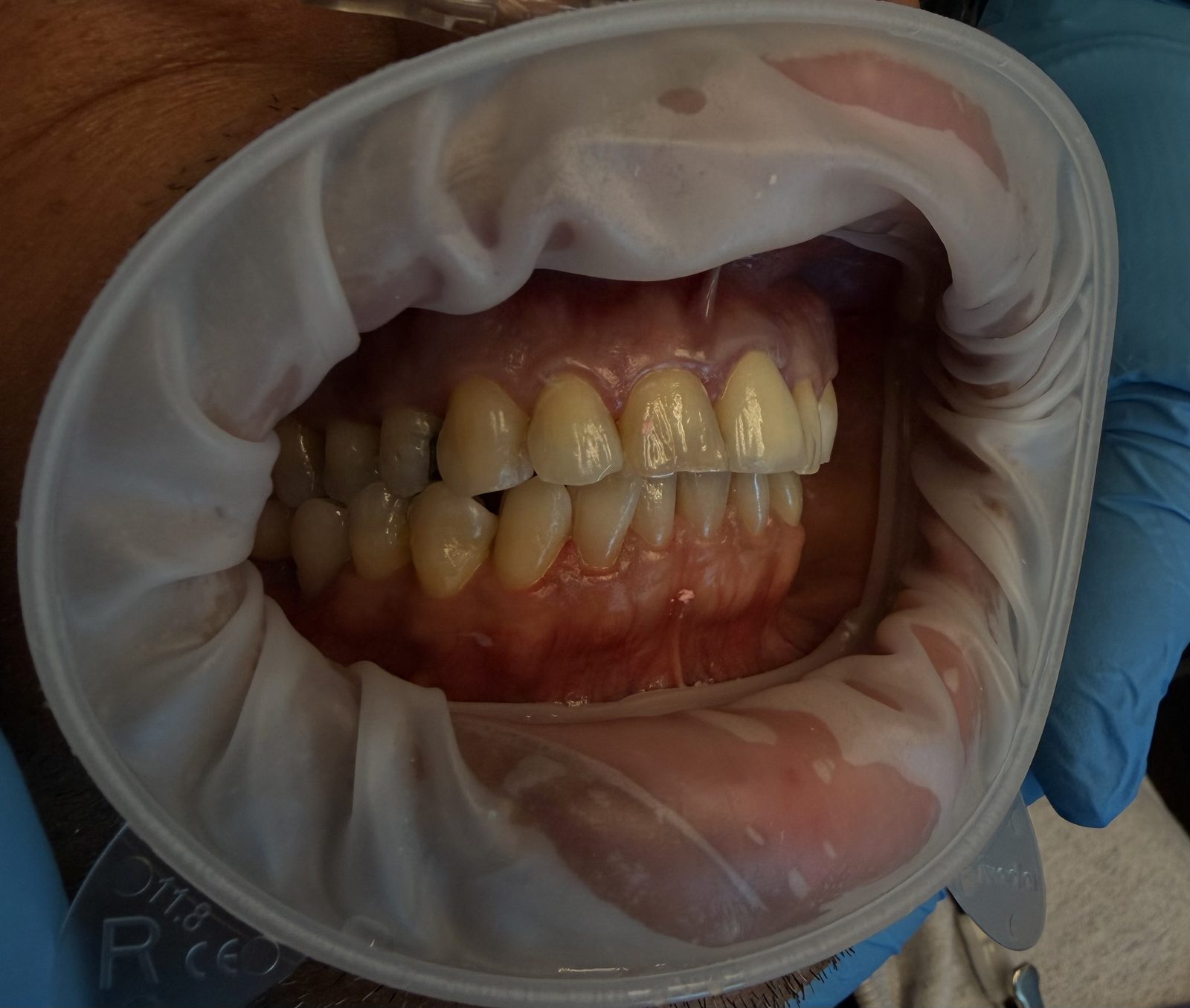 Intraoral view of a patient's teeth during emergency dental care