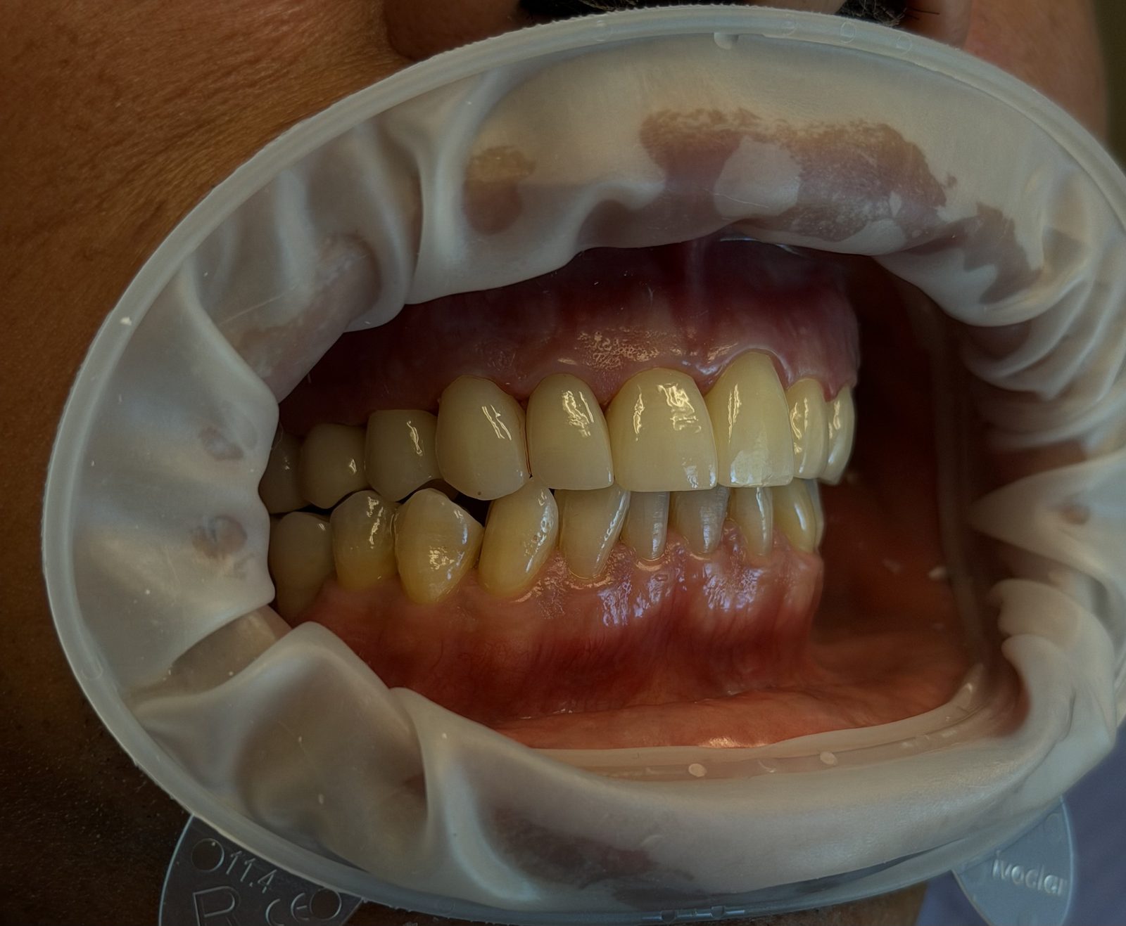 Intraoral view of a patient's smile during a routine visit