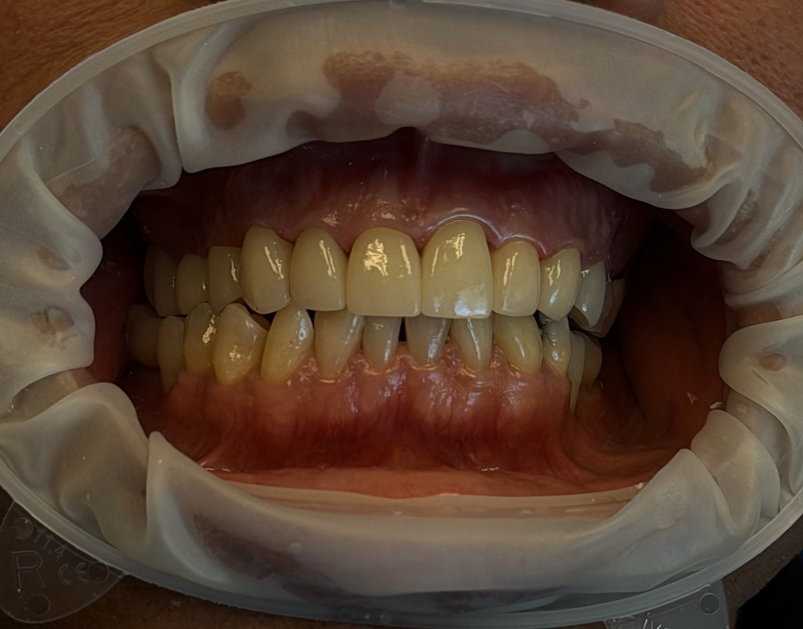 Intraoral view of a patient's teeth and gums during implant treatment