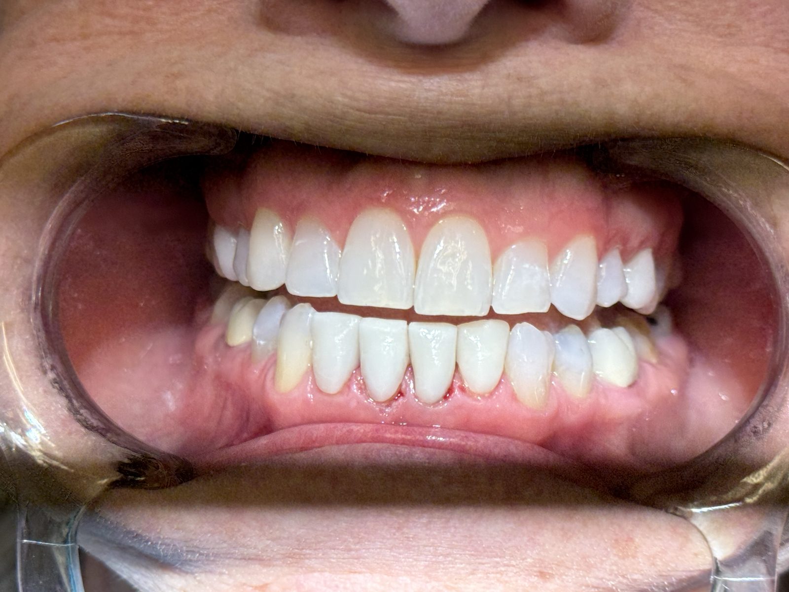 Intraoral view of a patient's smile during veneer treatment