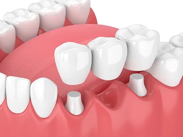 3D rendering of a dental bridge placed over a missing tooth gap