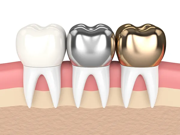 Cross-section view of three teeth with dental crowns made of different materials