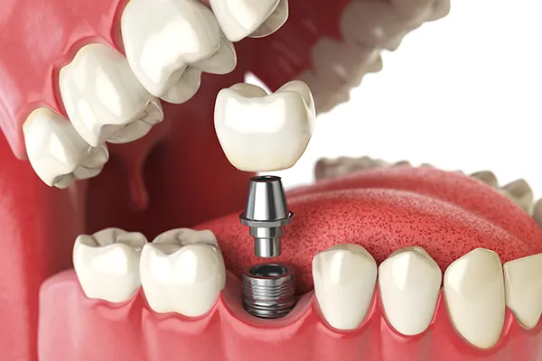 A dental implant being placed, showing the implant post, abutment, and crown in a jaw model