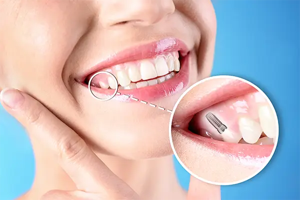 Smiling woman pointing to her teeth with dental implants at Highridge Dental Care