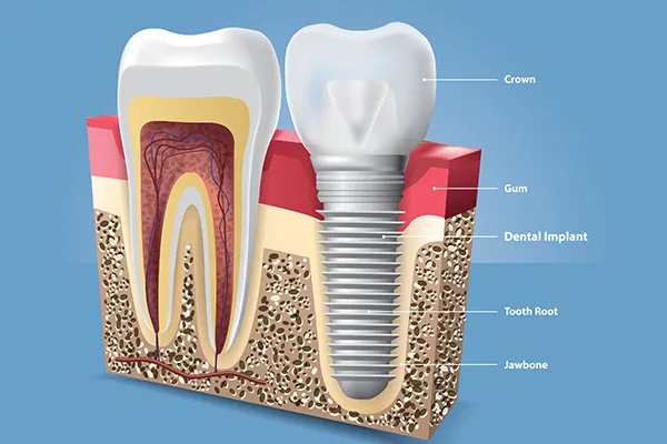 A labeled cross-section of a dental implant, showing the crown, abutment, post, and integration into the jawbone
