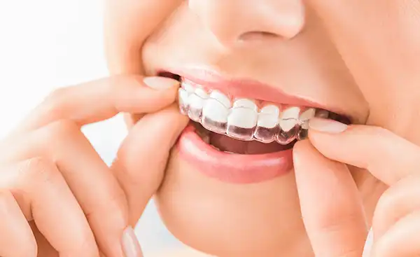 A young woman putting in an Invisalign clear aligner at Highridge Dental Care