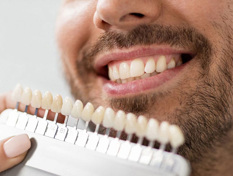 Comparing veneer shade options against a smile