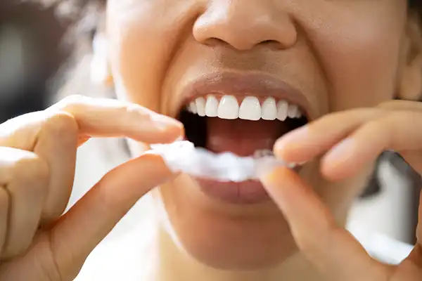 A young woman putting in a mouth guard at Highridge Dental Care