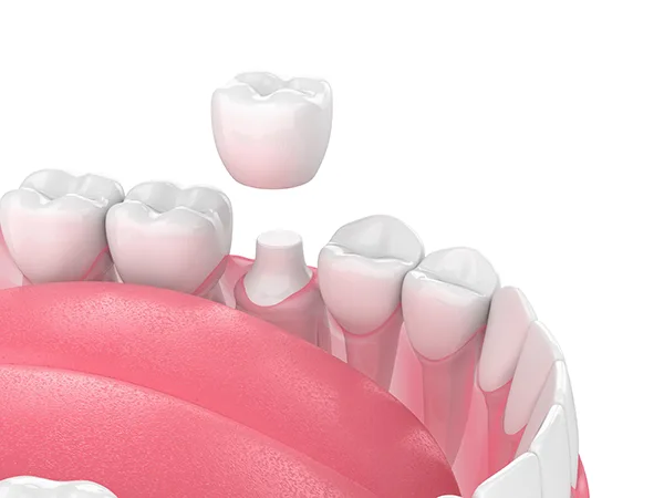 A porcelain crown being placed on top of a prepared tooth