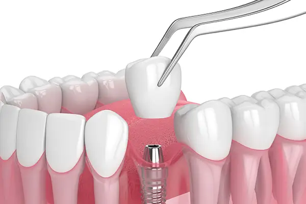 Close-up of a dental implant with crown being placed on the implant